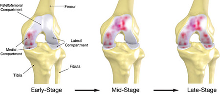 knee pain