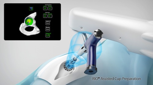 hip replacement